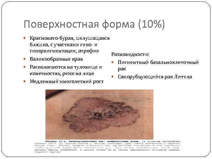 Поверхностная форма (10%) Красновато-бурая, шелушащаяся бляшка, с участками гипо- и гиперпигментации, атрофии Валикообразные края