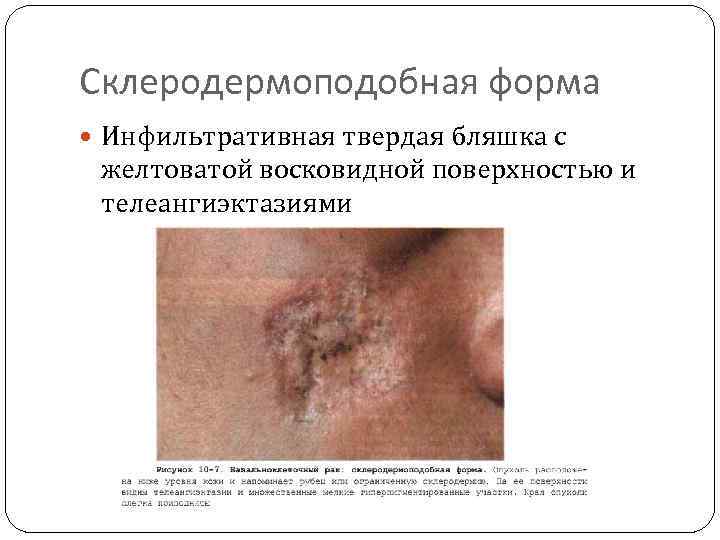 Склеродермоподобная форма Инфильтративная твердая бляшка с желтоватой восковидной поверхностью и телеангиэктазиями 