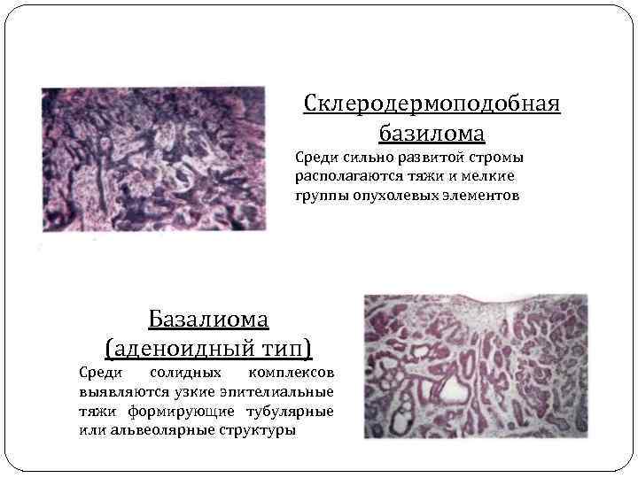 Склеродермоподобная базилома Среди сильно развитой стромы располагаются тяжи и мелкие группы опухолевых элементов Базалиома