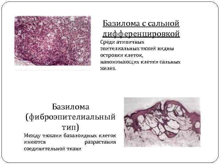 Базилома с сальной дифференцировкой Среди атипичных эпителиальных тяжей видны островки клеток, напоминающих клетки сальных