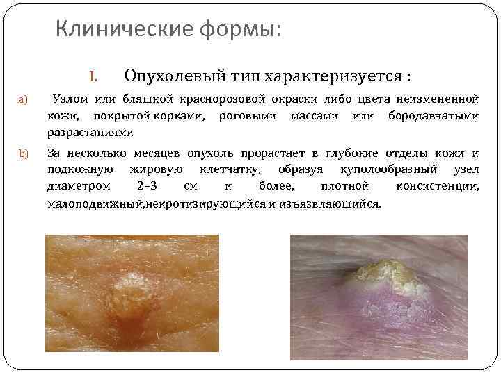 Клинические формы: I. Опухолевый тип характеризуется : a) Узлом или бляшкой краснорозовой окраски либо