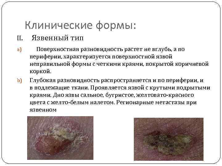 Клинические формы: II. Язвенный тип a) b) Поверхностная разновидность растет не вглубь, а по