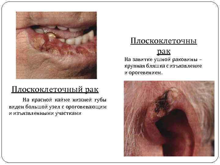 Плоскоклеточны рак На завитке ушной раковины – крупная бляшка с изъязвление и орогевением. Плоскоклеточный