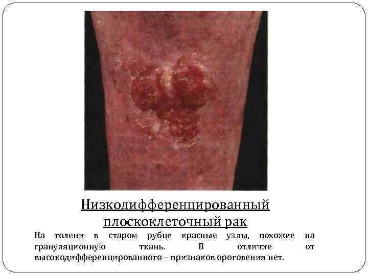 Низкодифференцированный плоскоклеточный рак На голени в старом рубце красные узлы, похожие на грануляционную ткань.