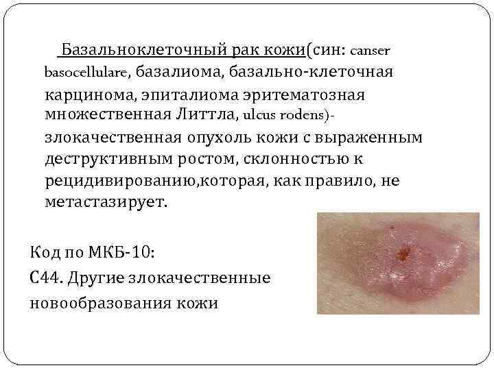  Базальноклеточный рак кожи(син: canser basocellulare, базалиома, базально-клеточная карцинома, эпиталиома эритематозная множественная Литтла, ulcus
