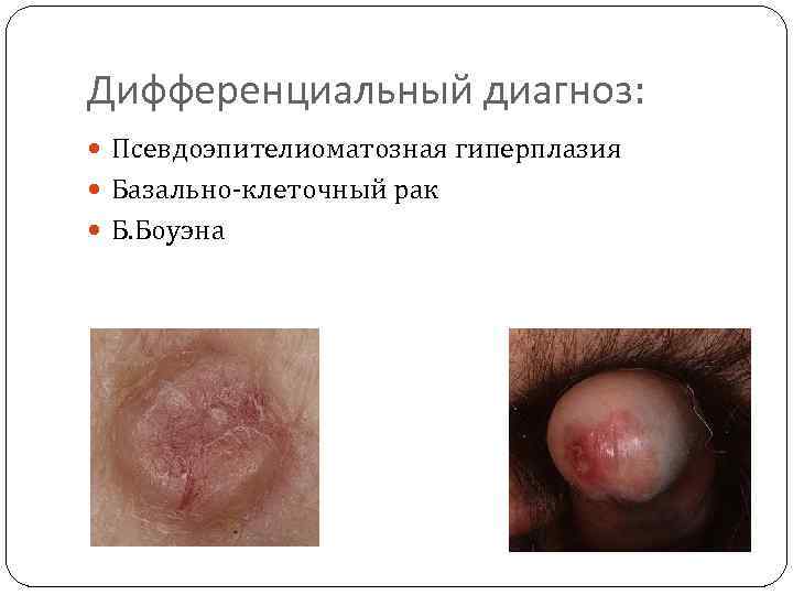 Дифференциальный диагноз: Псевдоэпителиоматозная гиперплазия Базально-клеточный рак Б. Боуэна 