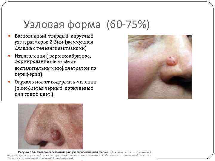 Узловая форма (60 -75%) Восковидный, твердый, округлый узел, размеры: 2 -5 мм (жемчужная бляшка