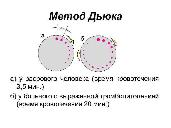 Метод Дьюка а) у здорового человека (время кровотечения 3, 5 мин. ) б) у