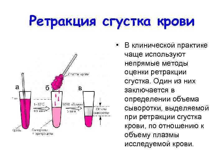 Ретракция сгустка крови • В клинической практике чаще используют непрямые методы оценки ретракции сгустка.