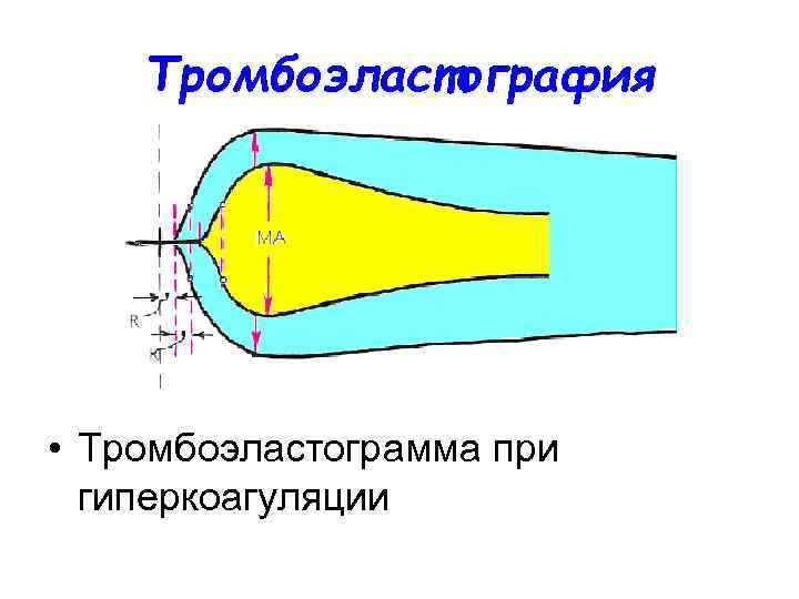 Тромбоэластография • Тромбоэластограмма при гиперкоагуляции 