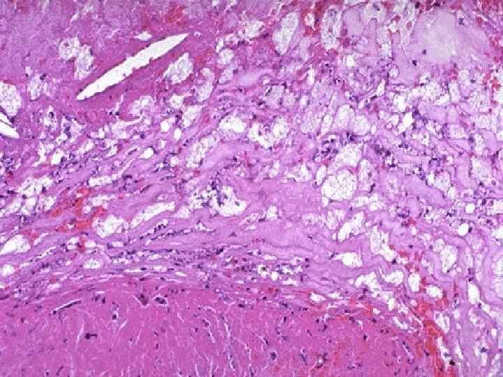This high magnification of the atheroma shows numerous foam cells and an occasional cholesterol