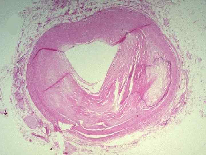 The coronary artery shown here has narrowing of the lumen due to build up