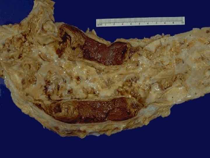 This aorta has been opened longitudinally to reveal an area of fairly limited dissection