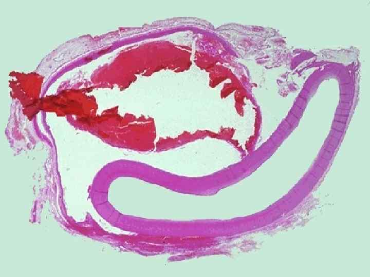 This microscopic cross section of the aorta demonstrates a red blood clot that is