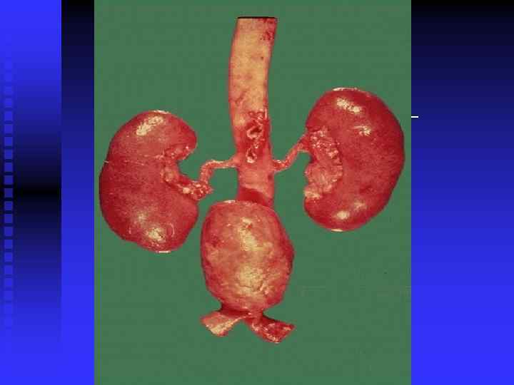 Atherosclerosis may weaken the wall of the aorta such that it bulges out to