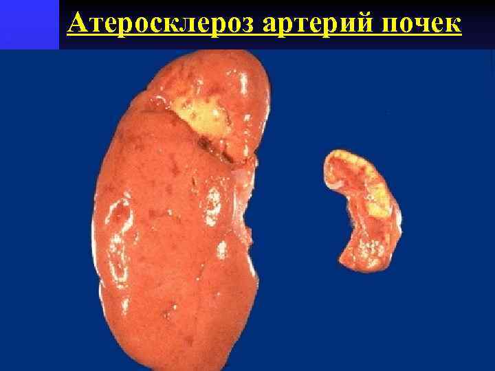 Атеросклероз артерий почек 