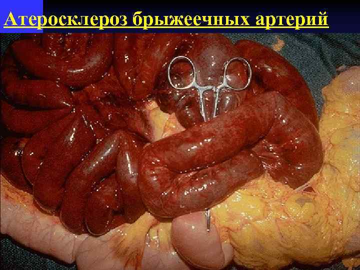 Атеросклероз брыжеечных артерий 