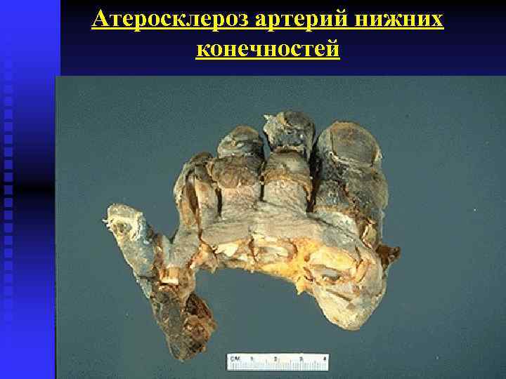 Атеросклероз артерий нижних конечностей 