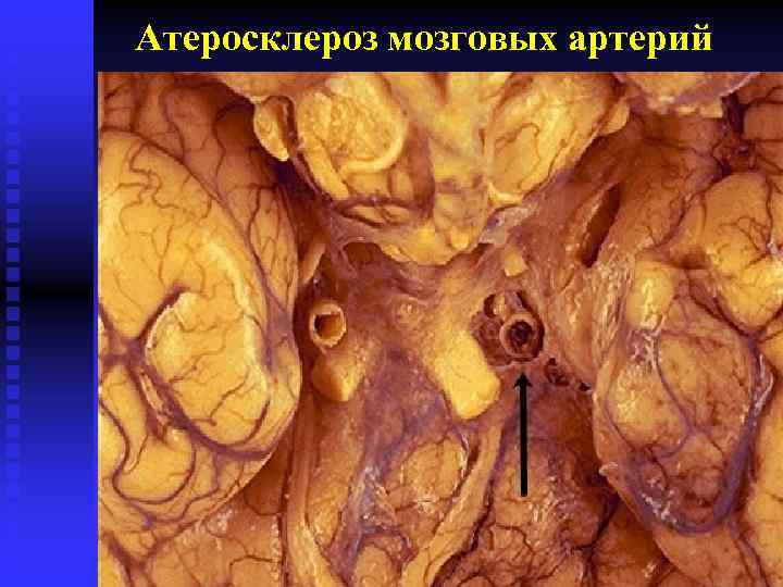 Атеросклероз мозговых артерий 