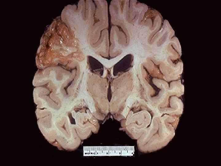 This is an intermediate to remote infarct in the distribution of the middle cerebral