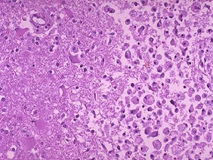 This cerebral infarction demonstrates the presence of many macrophages at the right which are