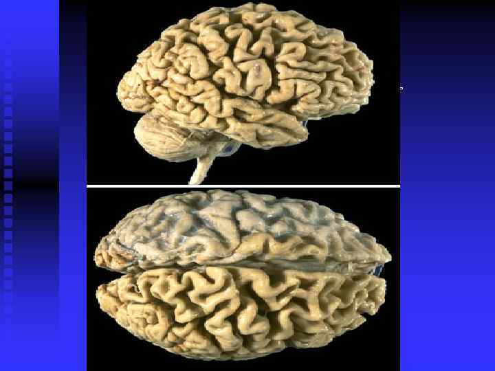 In this case of Alzheimer's disease, there is more marked atrophy seen superiorly and