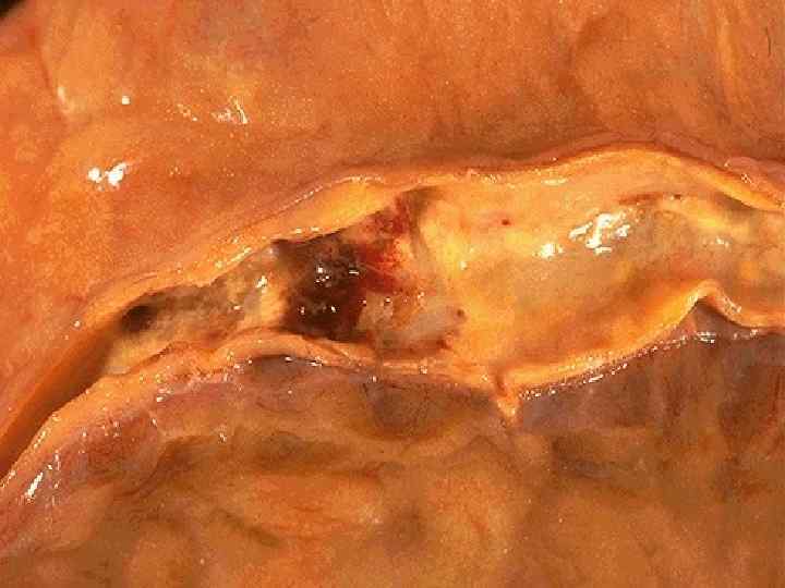 This is coronary atherosclerosis with the complication of hemorrhage into atheromatous plaque, seen here