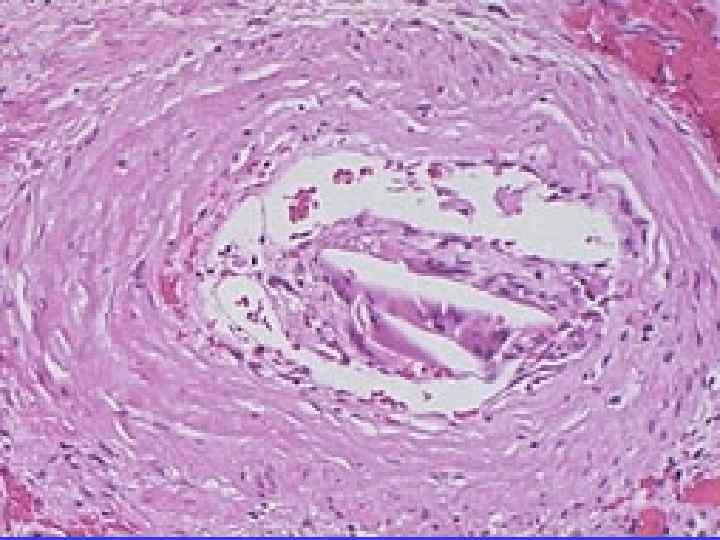 Despite the frequency of aortic atherosclerosis, cholesterol emboli are rare, or at least insignficant