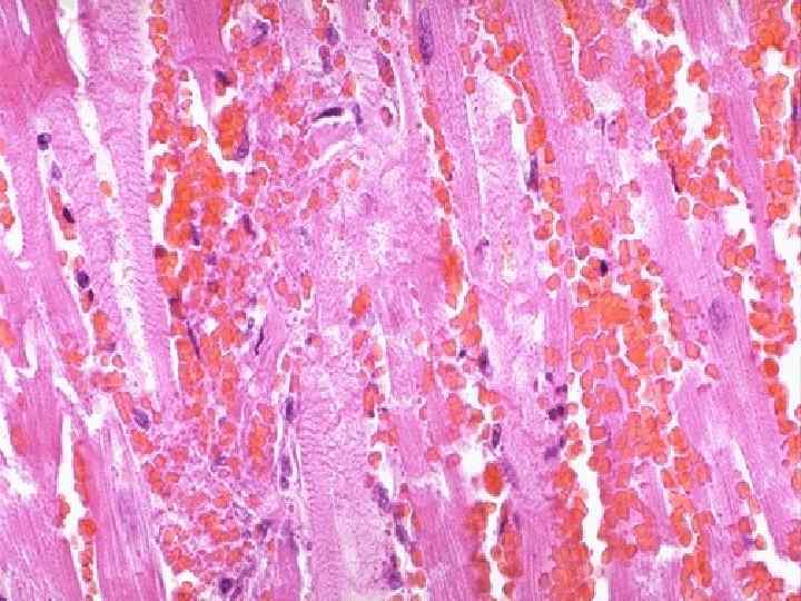 In this microscopic view of a recent myocardial infarction, there is extensive hemorrhage along