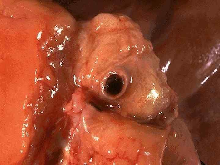 A thrombosis of a coronary artery is shown here in cross section. This acute