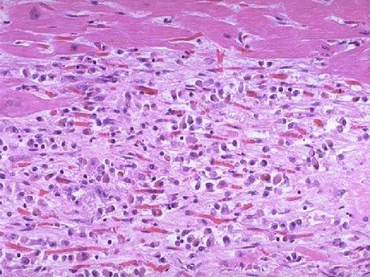 This is an intermediate myocardial infarction of 1 to 2 weeks in age. Note