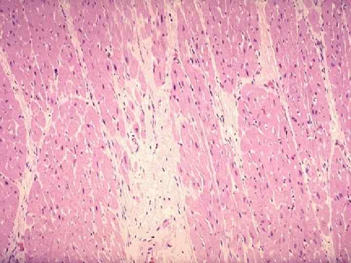 There is pale white collagen within the interstitium between myocardial fibers. This represents an