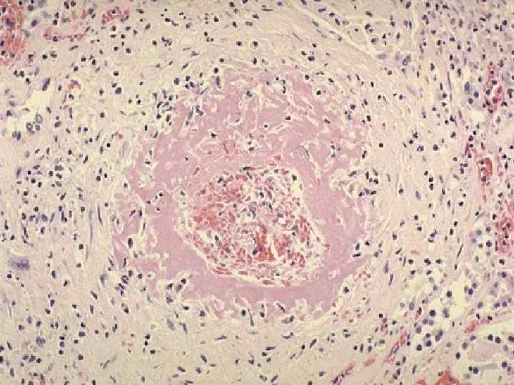 One complication of hyperplastic arteriolosclerosis with malignant hypertension is fibrinoid necrosis, as seen here