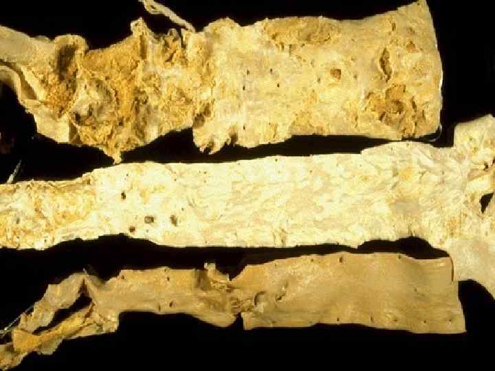 These three aortas demonstrate mild, moderate, and severe atherosclerosis from bottom to top. At