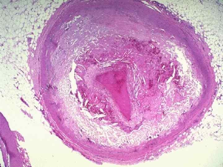 There is a pink to red recent thrombosis in this narrowed coronary artery. The