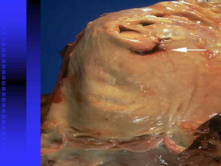 There is a tear (arrow) located 7 cm above the aortic valve and proximal