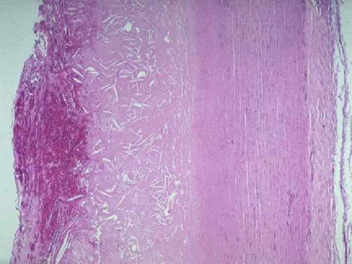 This microscopic cross section of the aorta shows a large overlying atheroma on the