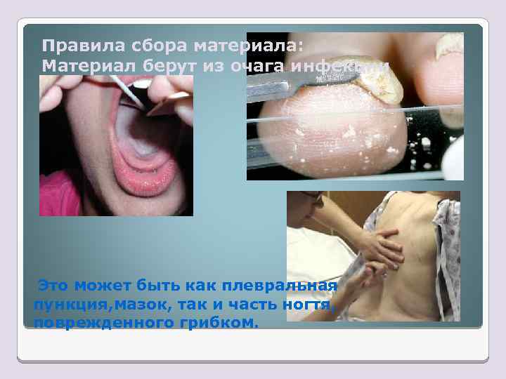 Правила сбора материала: Материал берут из очага инфекции Это может быть как плевральная пункция,