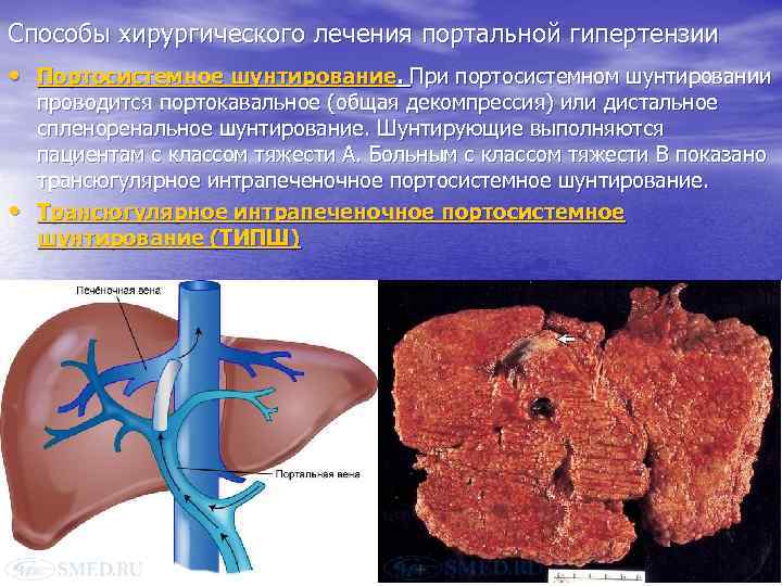 Способы хирургического лечения портальной гипертензии • Портосистемное шунтирование. При портосистемном шунтировании • проводится портокавальное