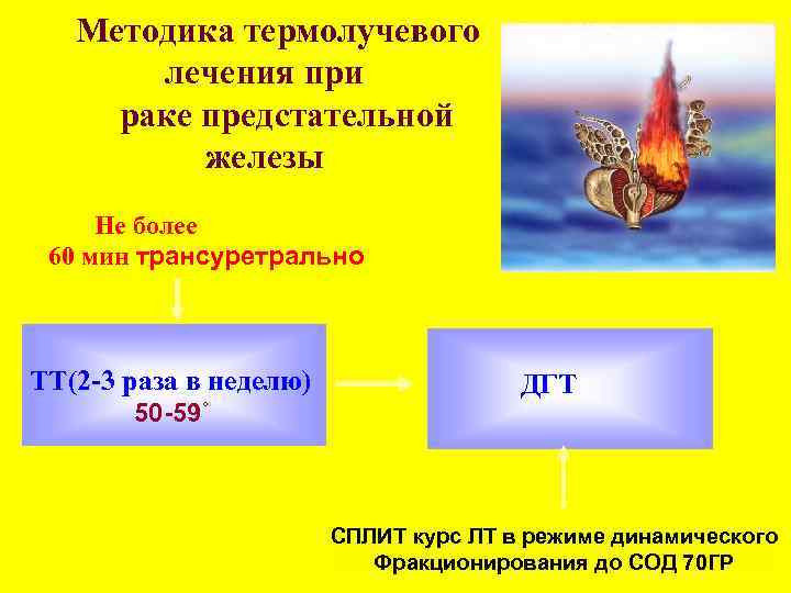 Методика термолучевого лечения при раке предстательной железы Не более 60 мин трансуретрально ТТ(2 -3