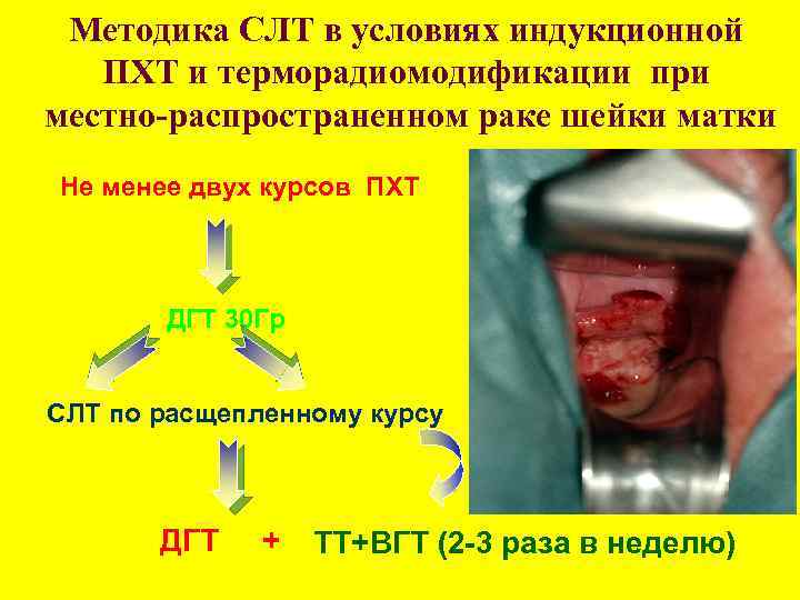 Методика СЛТ в условиях индукционной ПХТ и терморадиомодификации при местно-распространенном раке шейки матки Не