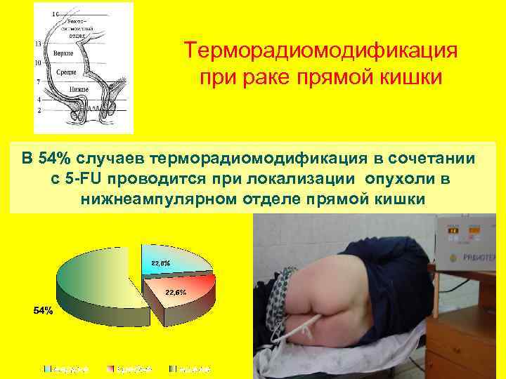 Терморадиомодификация при раке прямой кишки В 54% случаев терморадиомодификация в сочетании с 5 -FU