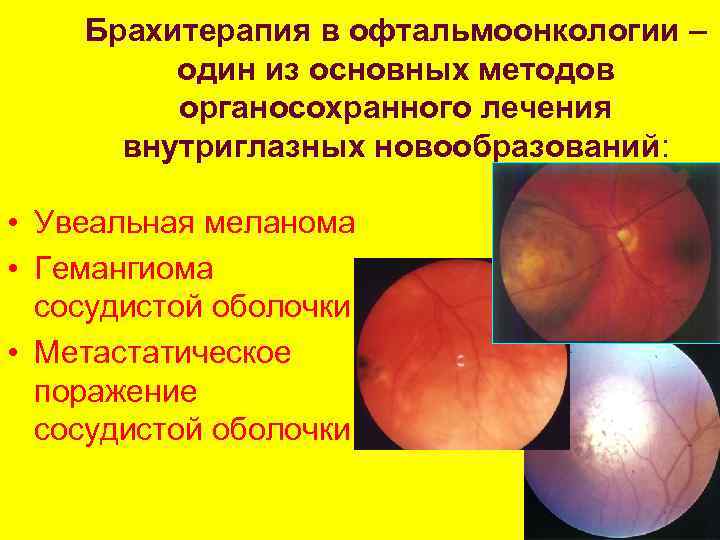 Брахитерапия в офтальмоонкологии – один из основных методов органосохранного лечения внутриглазных новообразований: • Увеальная