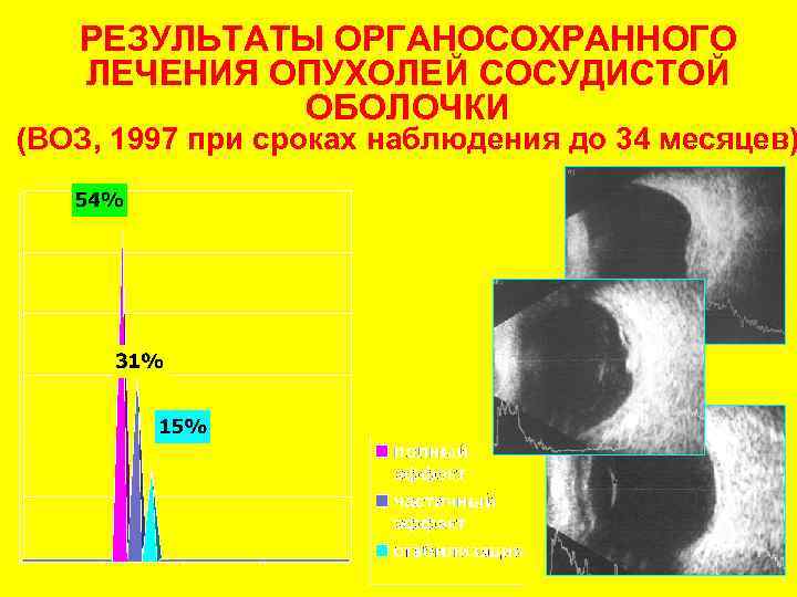 РЕЗУЛЬТАТЫ ОРГАНОСОХРАННОГО ЛЕЧЕНИЯ ОПУХОЛЕЙ СОСУДИСТОЙ ОБОЛОЧКИ (ВОЗ, 1997 при сроках наблюдения до 34 месяцев)