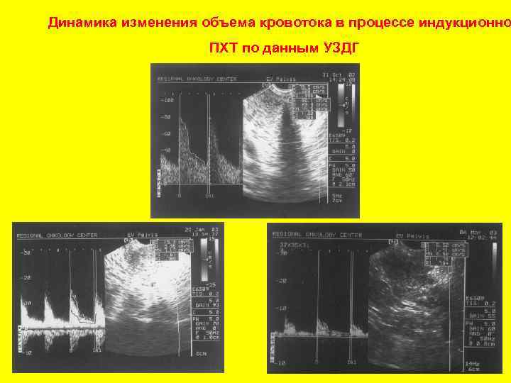 Динамика изменения объема кровотока в процессе индукционно ПХТ по данным УЗДГ 