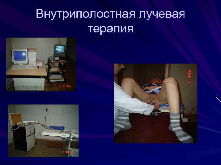 Внутриполостная лучевая терапия 