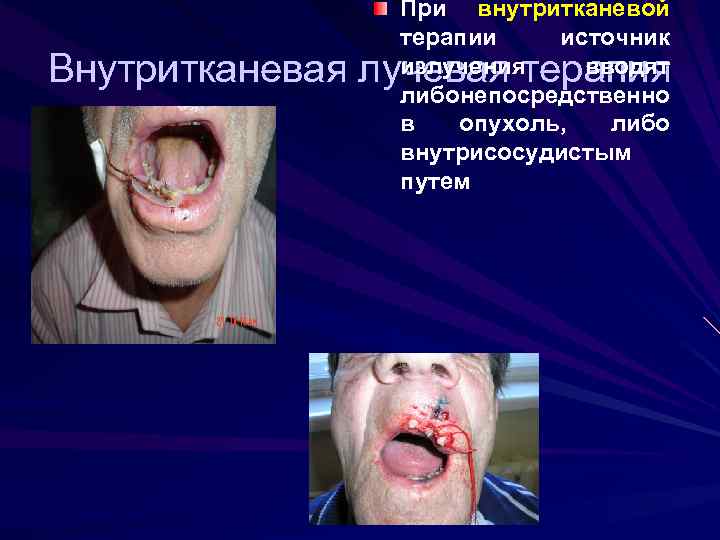 При внутритканевой терапии источник излучения вводят либо епосредственно н в опухоль, либо внутрисосудистым путем