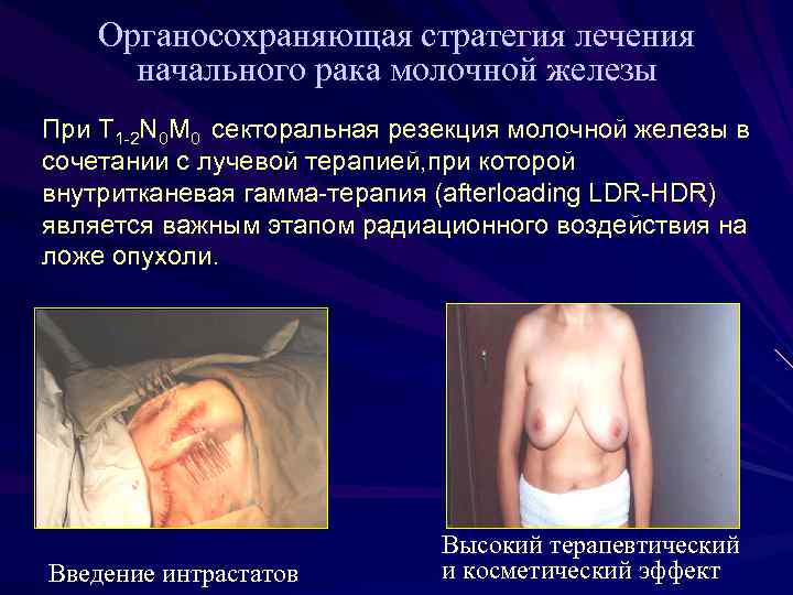 Органосохраняющая стратегия лечения начального рака молочной железы При T 1 -2 N 0 M