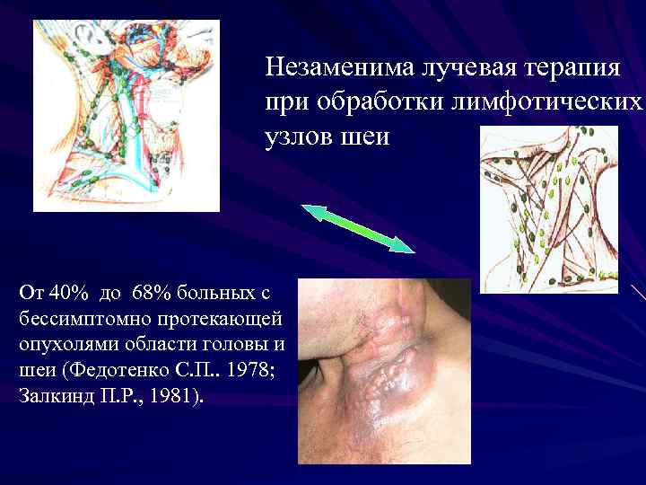 Незаменима лучевая терапия при обработки лимфотических узлов шеи От 40% до 68% больных с