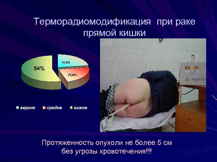 Терморадиомодификация при раке прямой кишки 54% Протяженность опухоли не более 5 см без угрозы